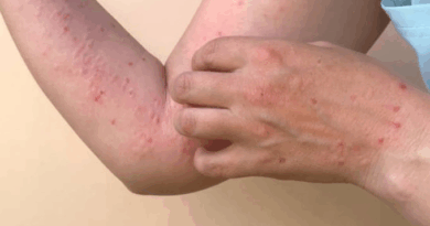 MÉXICO REGISTRA 23 MUERTES Y MÁS DE 5,200 CASOS DE SARAMPIÓN ASOCIADOS A BROTE INICIADO EN FEBRERO