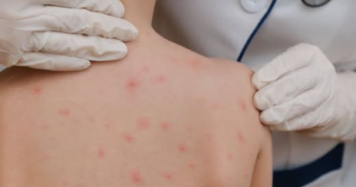 ALERTA SANITARIA EN MÉXICO: BROTE DE SARAMPIÓN DEJA CERCA DE 30 MUERTES